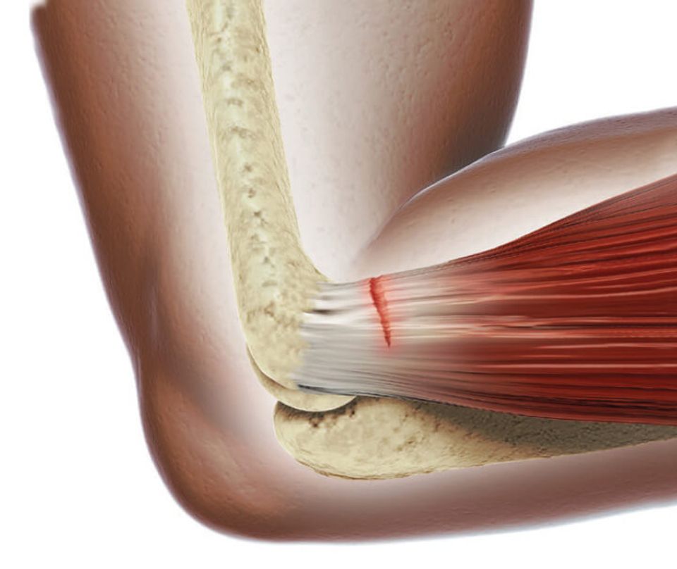 Infographic of a tear in a tendon