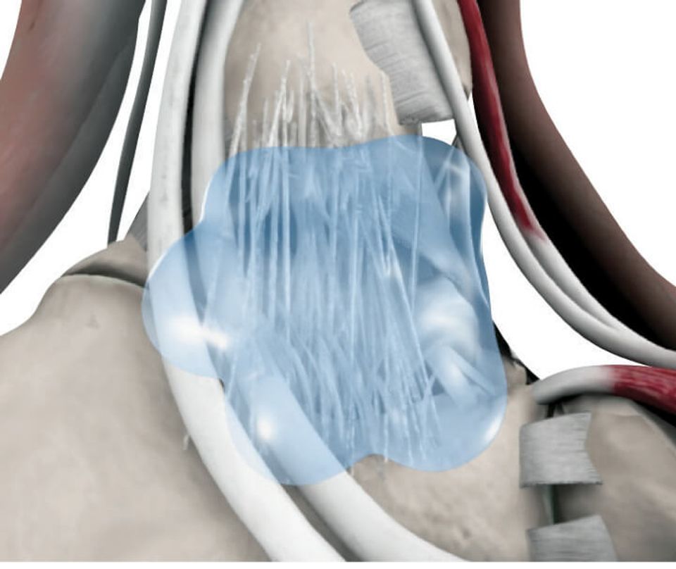 Infographic of a tear in a ankle covered witch sportvis